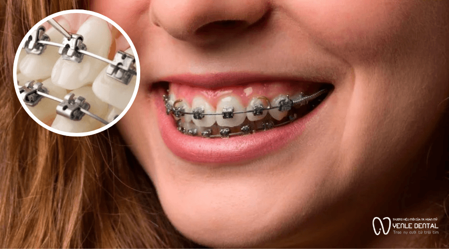 niềng răng mắc cài tự động